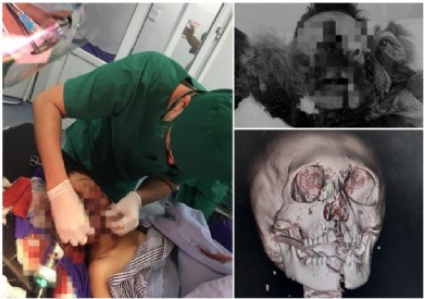 Phẫu thuật kịp thời cứu bệnh nhi 9 tuổi tổn thương phức tạp vùng hàm mặt do pháo tự chế